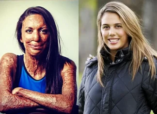 Modelul care a supraviețuit unor arsuri grave primește cea mai bună veste din viața ei