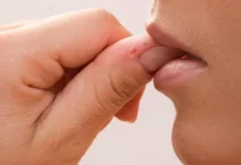 Îți muști pielea degetelor? Poți avea dermatofagie.