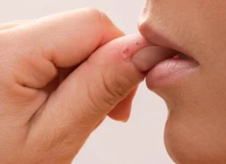 Îți muști pielea degetelor? Poți avea dermatofagie.